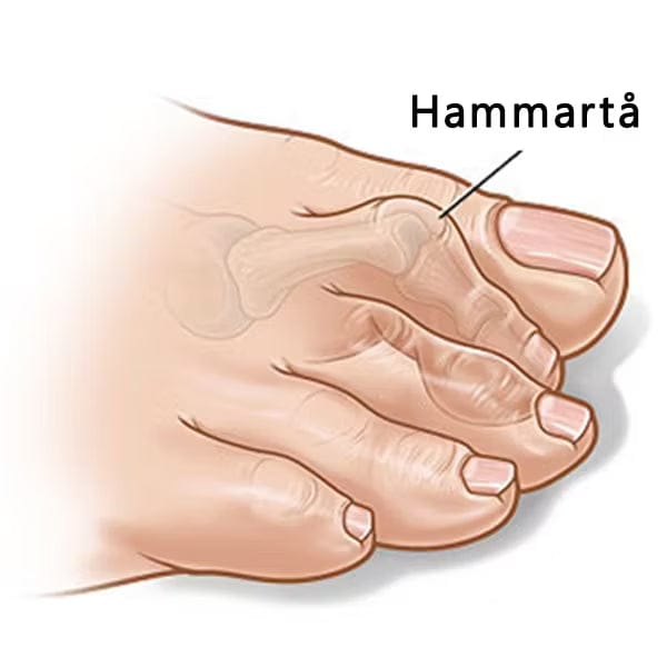 Kroppsbutiken Fodstøtte Hammer tå forfodsstøtte (2 stk)